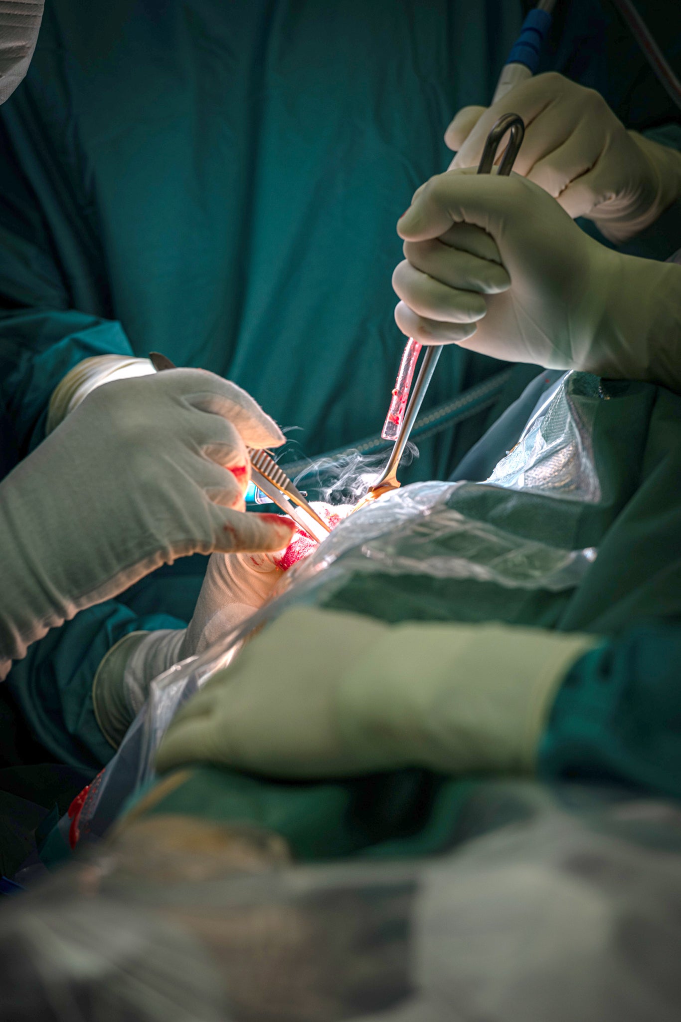Operation bei der Chirurgische Rauchgase entstehen