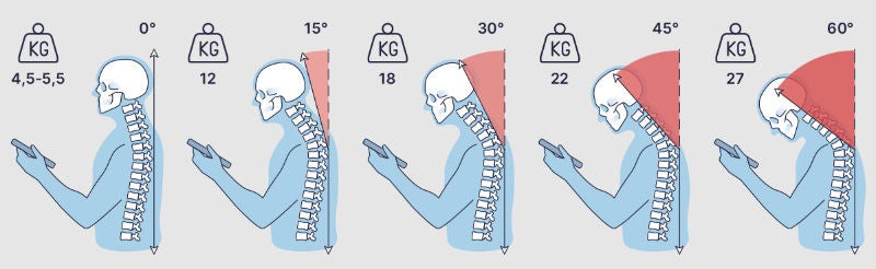 Illustration zur Belastung der Halswirbelsäule in Abhängigkeit vom Neigungswinkel des Kopfes beim Blick auf ein Smartphone. Je stärker die Neigung, desto höher die Belastung in Kilogramm.